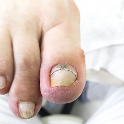 Услуги Центра Подологии и Ортопедии «TotalPodiatry» со скидкой до 50%!