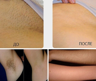 Лазерная эпиляция со скидкой до 82% в салоне красоты «ELVIRA_BEAUTY_LOUNGE» Лазерная эпиляция со скидкой до 82% в салоне красоты «ELVIRA_BEAUTY_LOUNGE»