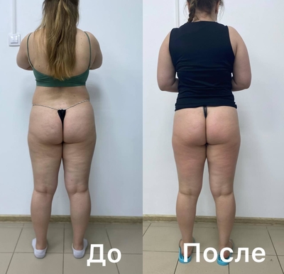 Преобразите своё тело в студии коррекции фигуры «PROмята» со скидкой до 52%