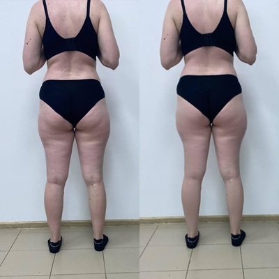 Преобразите своё тело в студии коррекции фигуры «PROмята» со скидкой до 52%