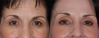 Скидка до 56% на косметологические услуги в студии «Тонус»!