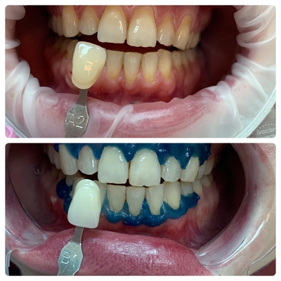 Стоматологическая клиника «Маг-Дент-Наири» дарит скидку до 71%! Стоматологическая клиника «Маг-Дент-Наири» дарит скидку до 71%!