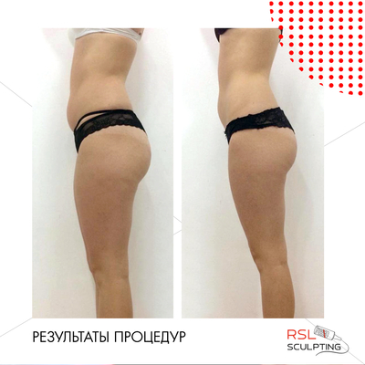 Фигура вызывающая восторг! RSL-скульптурирование и многое другое со скидкой до 61% в «Клинике Красоты»! Фигура вызывающая восторг! RSL-скульптурирование и многое другое со скидкой до 61% в «Клинике Красоты»!