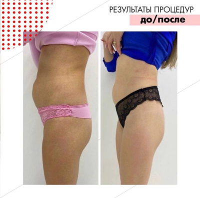 Фигура вызывающая восторг! RSL-скульптурирование и многое другое со скидкой до 61% в «Клинике Красоты»! Фигура вызывающая восторг! RSL-скульптурирование и многое другое со скидкой до 61% в «Клинике Красоты»!