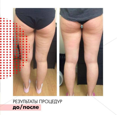 Фигура вызывающая восторг! RSL-скульптурирование и многое другое со скидкой до 61% в «Клинике Красоты»! Фигура вызывающая восторг! RSL-скульптурирование и многое другое со скидкой до 61% в «Клинике Красоты»!