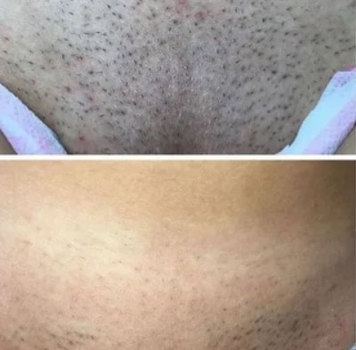 Лазерная эпиляция со скидкой до 82% в салоне красоты «ELVIRA_BEAUTY_LOUNGE» Лазерная эпиляция со скидкой до 82% в салоне красоты «ELVIRA_BEAUTY_LOUNGE»