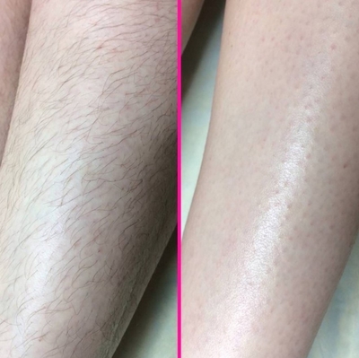 Лазерная эпиляция со скидкой до 82% в салоне красоты «ELVIRA_BEAUTY_LOUNGE» Лазерная эпиляция со скидкой до 82% в салоне красоты «ELVIRA_BEAUTY_LOUNGE»