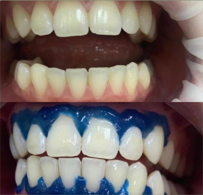 Улыбайтесь чаще! Стоматология «SMILE FOR YOU» дарит скидку до 60% Улыбайтесь чаще! Стоматология «SMILE FOR YOU» дарит скидку до 60%