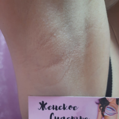 Лазерная эпиляция со скидкой до 50% в салоне «Женское счастье»!