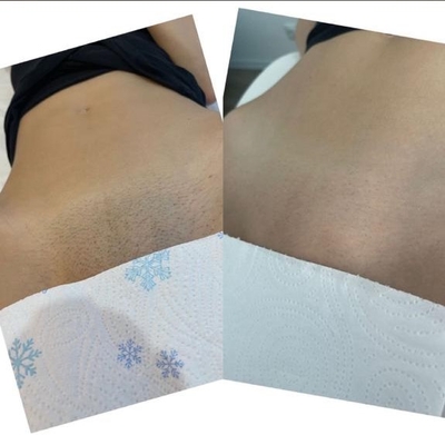 Удаление волос со скидкой до 70% в салоне красоты «Марафет»!