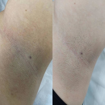 Лазерная эпиляция со скидкой до 71% в салоне красоты «Марафет»! Лазерная эпиляция со скидкой до 71% в салоне красоты «Марафет»!