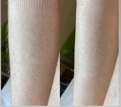 Лазерная эпиляция со скидкой до 71% в салоне красоты «Марафет»! Лазерная эпиляция со скидкой до 71% в салоне красоты «Марафет»!