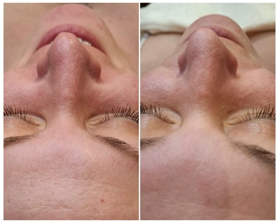 «Lady in Red»: косметологические процедуры со скидкой до 52% «Lady in Red»: косметологические процедуры со скидкой до 52%