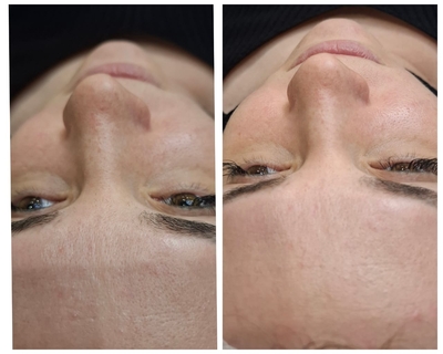 «Lady in Red»: косметологические процедуры со скидкой до 52% «Lady in Red»: косметологические процедуры со скидкой до 52%